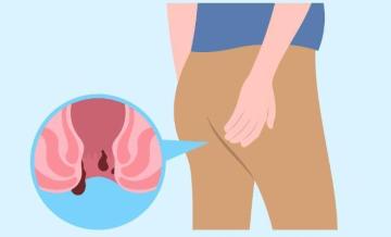 Advanced Kshar Sutra Treatment in Noida by Expert Doctors