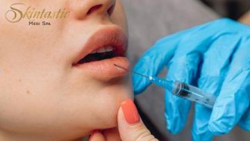 Affordable Lip Fillers Riverside for Perfect Volume