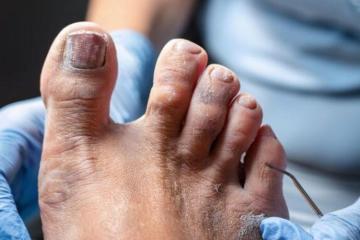 How Professional Foot Care Helps Prevent Diabetic Foot Complications