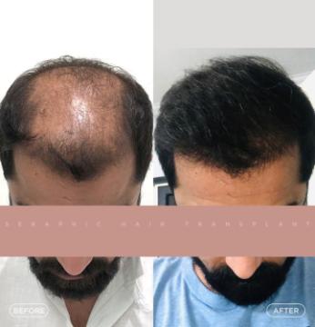 Best Hair Transplant in Indore – Expert Surgeons for Natural Hair Restoration