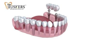 Best Dentist in CG Road