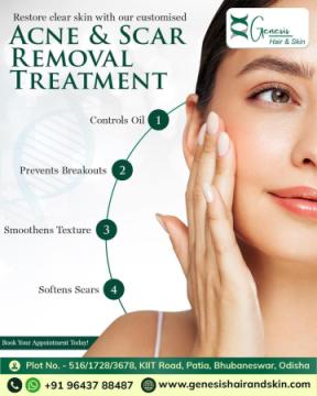 Acne treatment near me in Bhubaneswar
