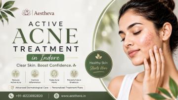 Active Acne Treatment in Indore – Aestheva