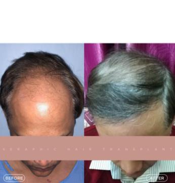 Best Hair Transplant in Indore – Expert Surgeons for Natural Hair Restoration