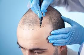 Best Hair Loss Clinic in Bangalore
