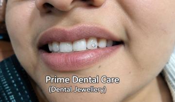 Give Your Smile a Stylish Touch with Tooth Jewellery in Prayagraj
