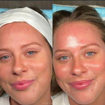 Hydrafacial Treatment in Mumbai for Improved Skin Texture and Radiance