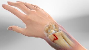 Wrist Fracture Specialist in South Delhi