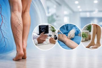 Varicose Veins Specialist in Chennai | Expert Vein Care