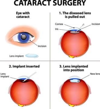Advanced Glaucoma Treatment in Andul – Dristipath Eye Hospital