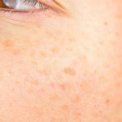 Age Spots Treatment Fort Collins | Even Skin Tone