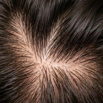 best hair loss shampoo for men